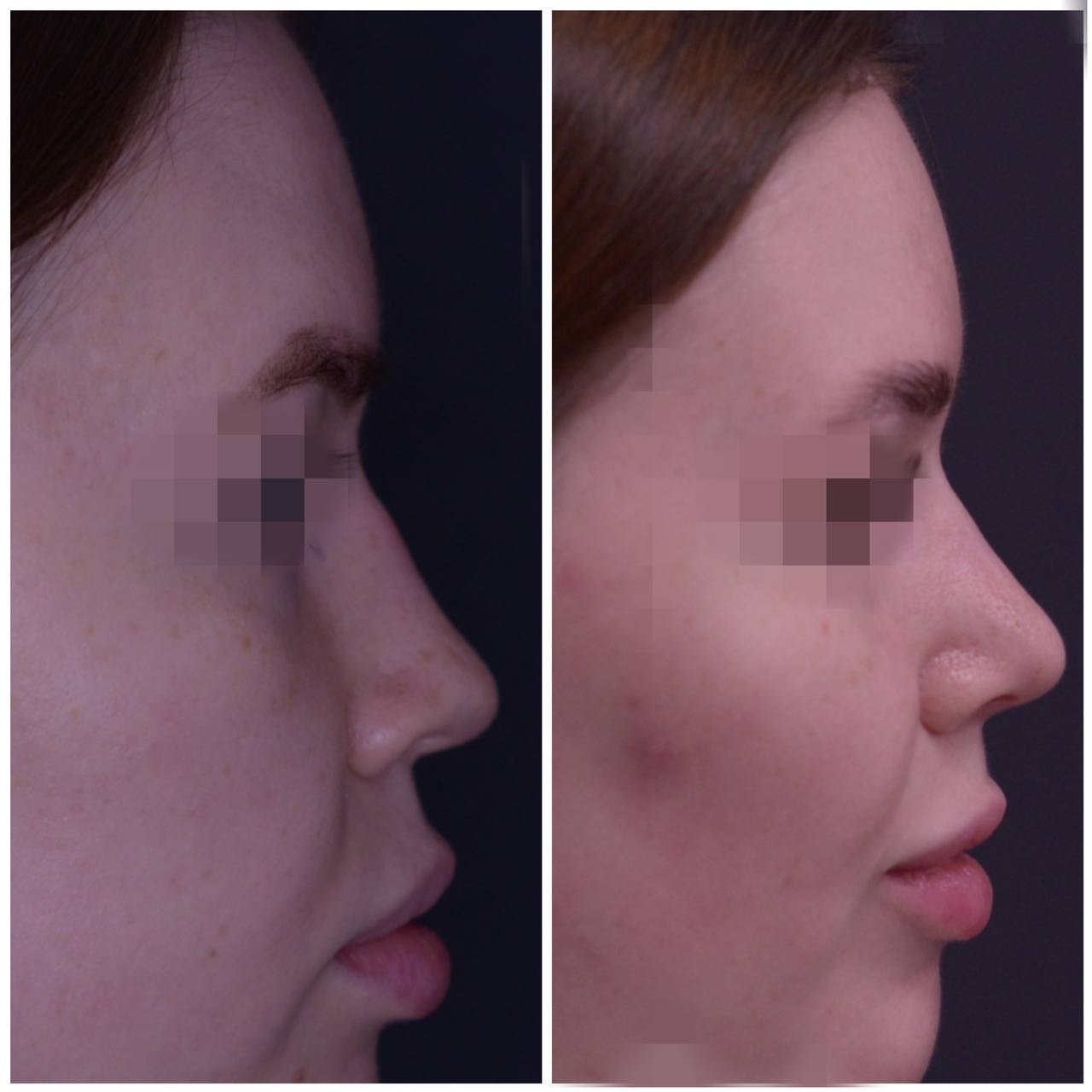 Коррекция асимметрии кончика носа седловидной деформации через 6 месяцев